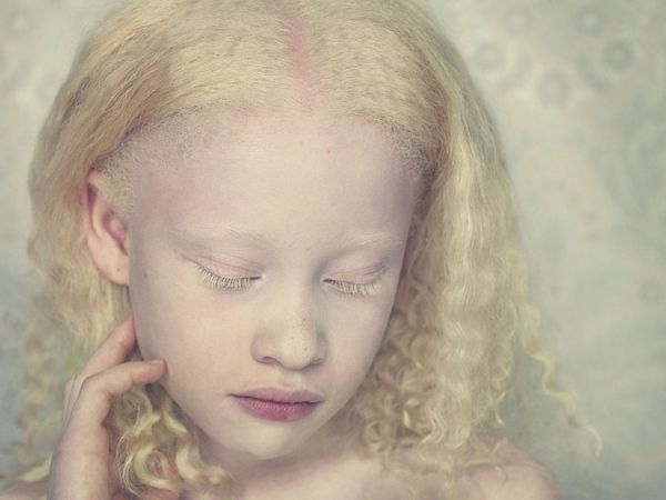 albino african americans