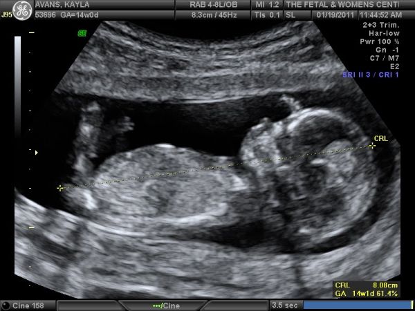 20 week ultrasound gender