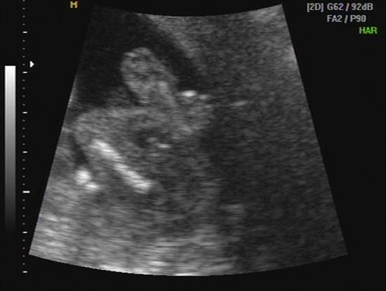 ultrasound fetal arms