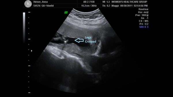 anencephaly ultrasound