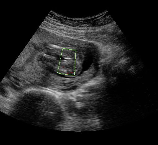 22 week ultrasound