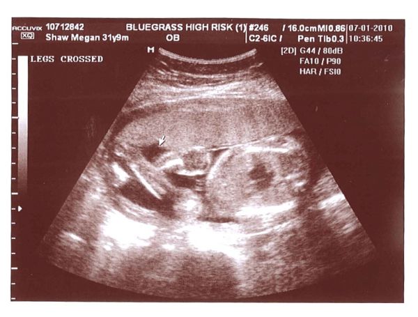 ultrasound fetal crossed hands