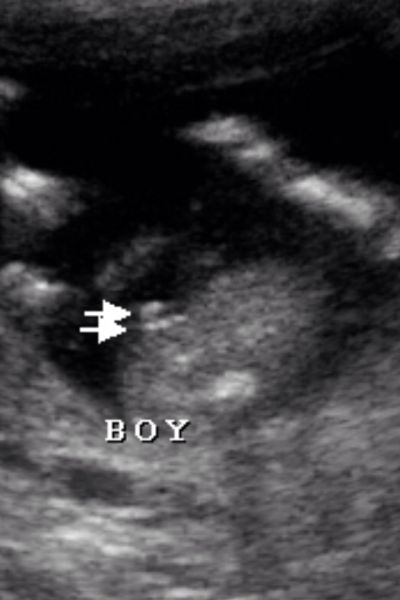 girl ultrasound
