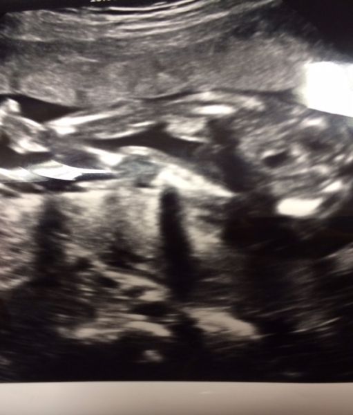 second trimester ultrasound