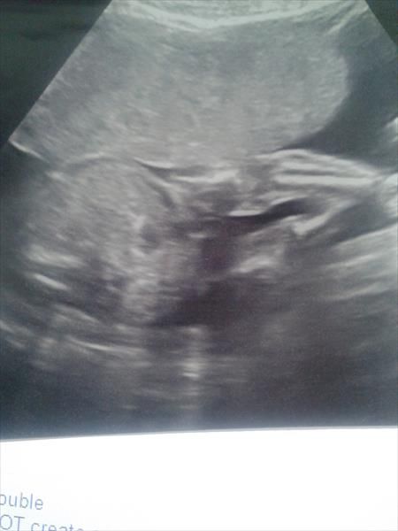 ultrasound fetal crossed arms