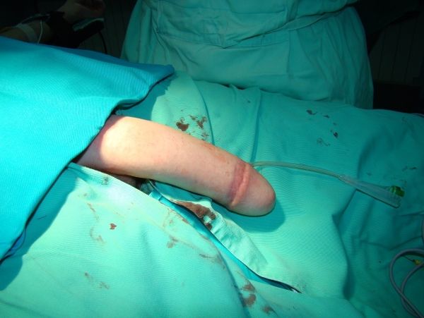 female genital cosmetic surgery