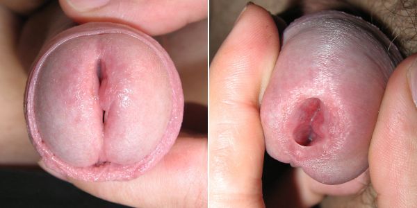 male pee urethra opening