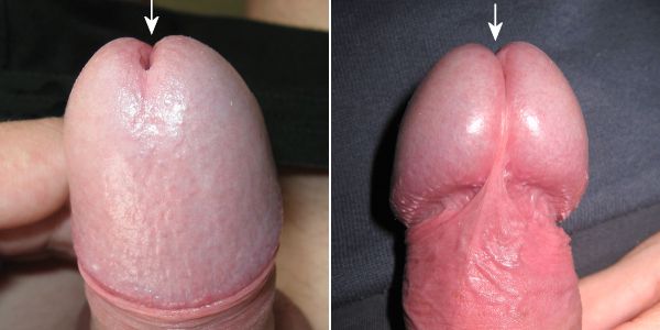 male urethra opening close ups