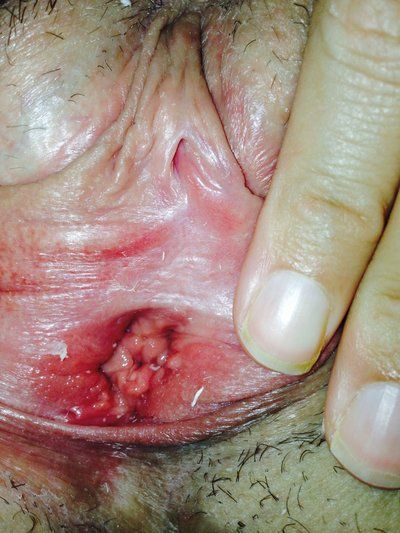 clitoral hood labia minora of vagina opening to measure from