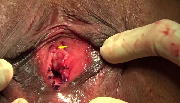 huge vaginal opening