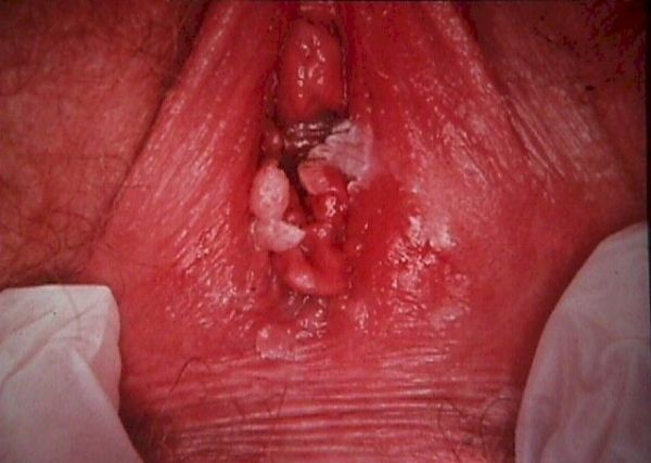 normal vagina opening heat rash