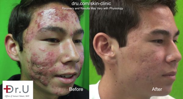 cystic acne before and after