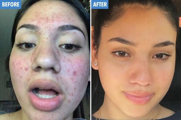 coconut oil acne before and after