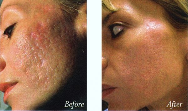 birth control acne before and after