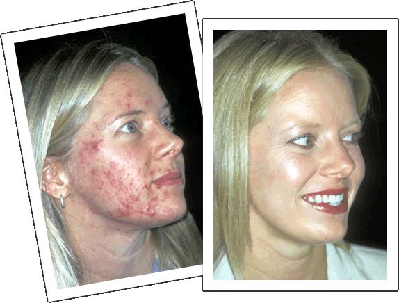 proactive acne before and after