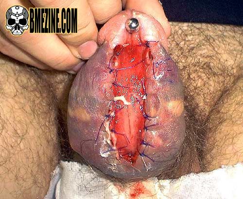 genital bisection