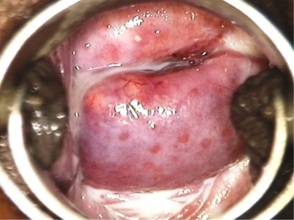 post menopausal cervix on the red spots
