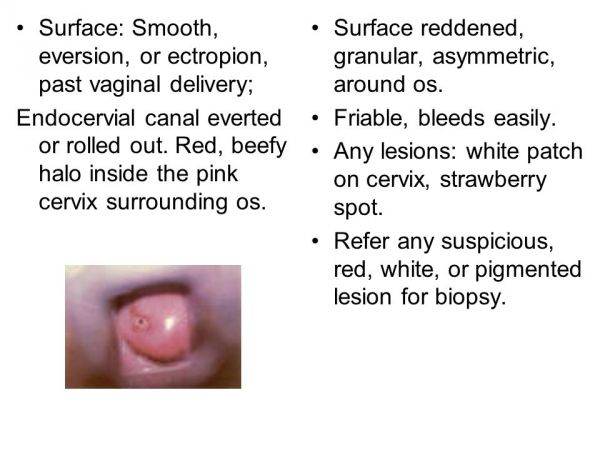 inflamed cervix