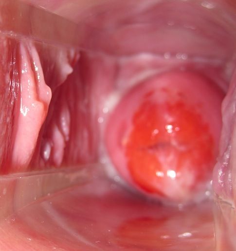 endometrial cells found on cervix