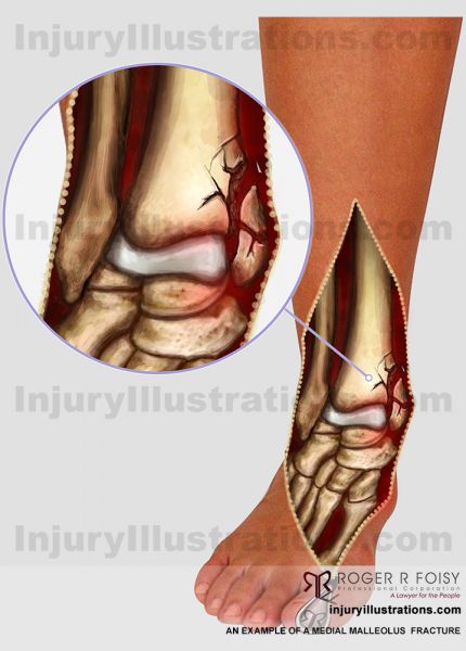 lateral malleolus sore