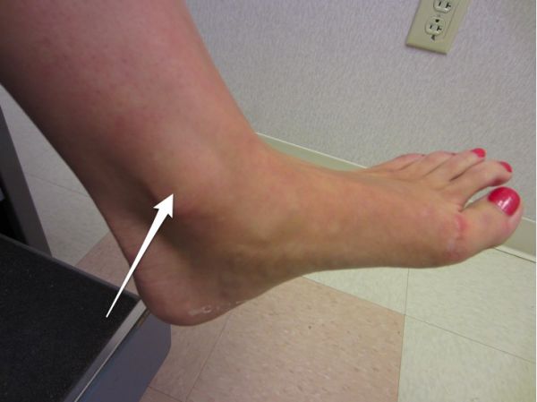 lateral heel pain