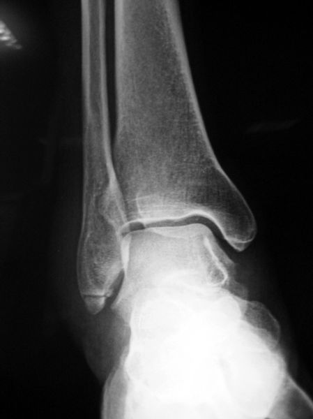 ankle lateral malleolus swelling