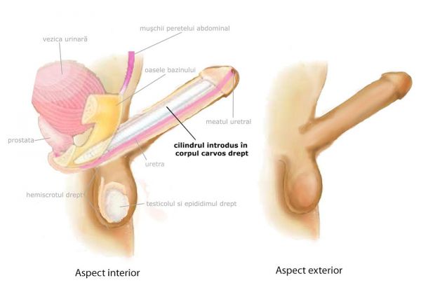 latest penile implants