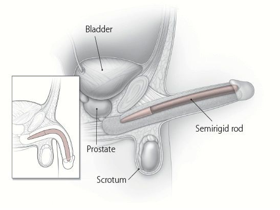 penile implant latest news