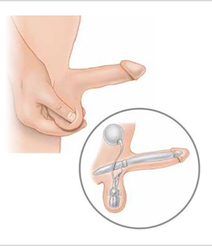 malleable penile implants