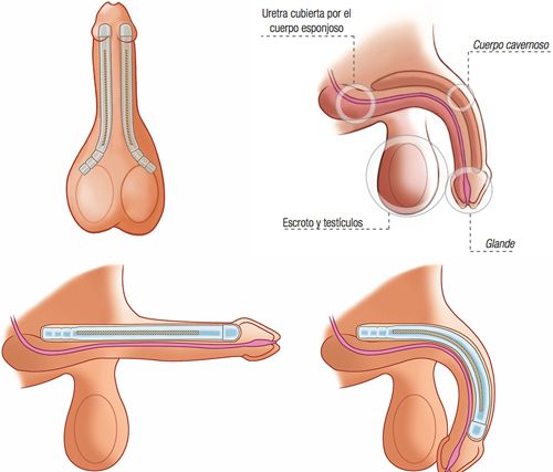 penile implant motorized
