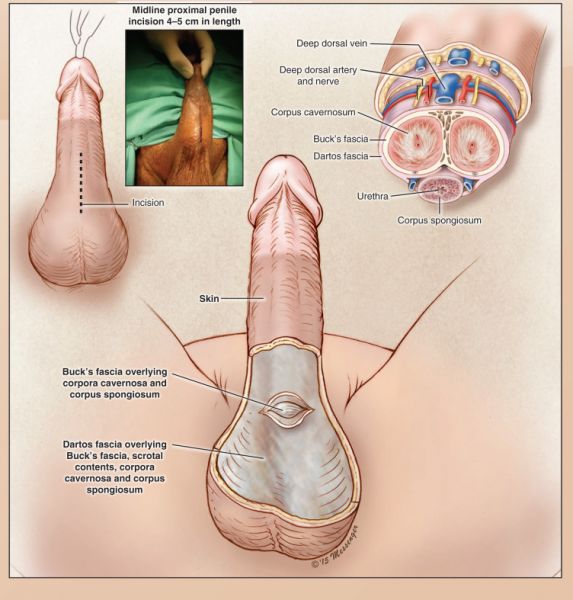 temp bendable rod penile implant