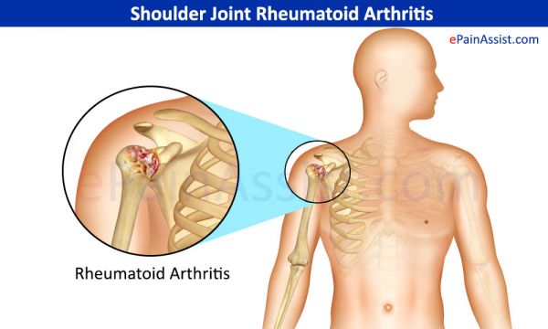 shoulder pain causes and treatment