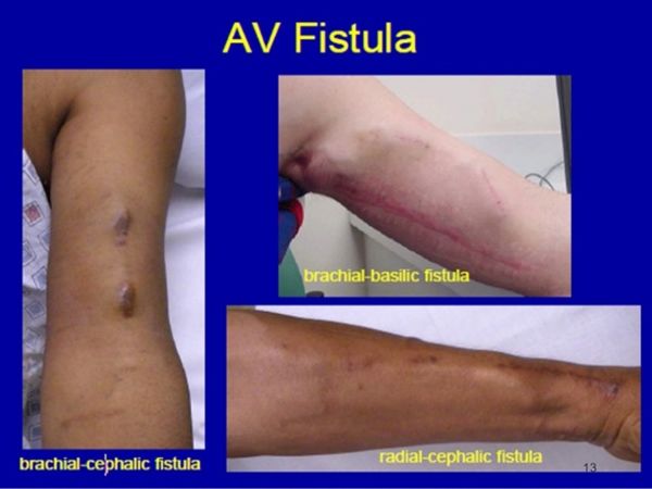 arteriovenous graft infection