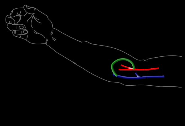 arteriovenous fistula for hemodialysis