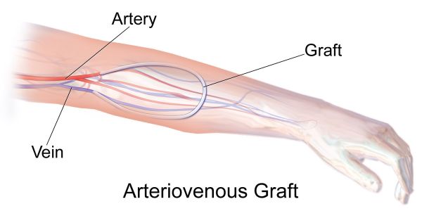 graft vs arteriovenous fistula