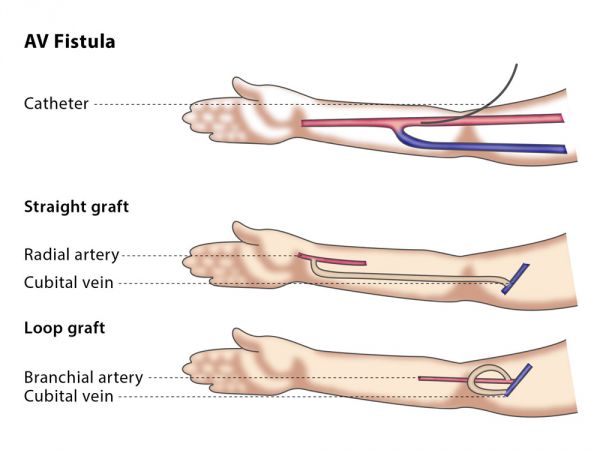 hemodialysis graft