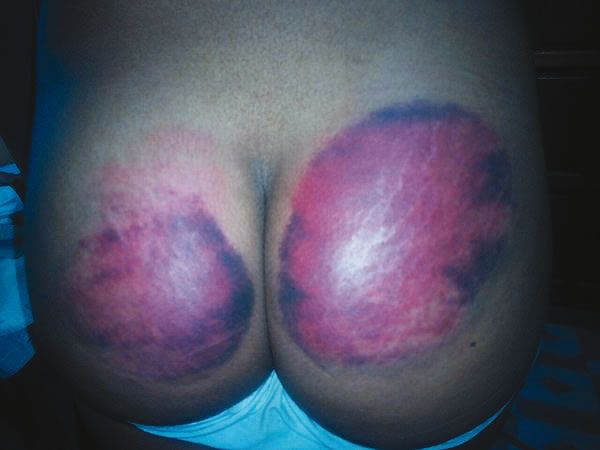 raymond mckoy bruised buttocks
