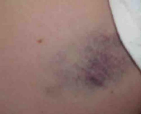 bruised buttocks from abuse