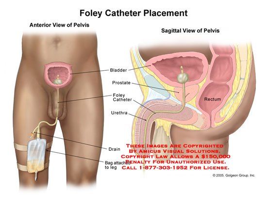 male catheter insertion