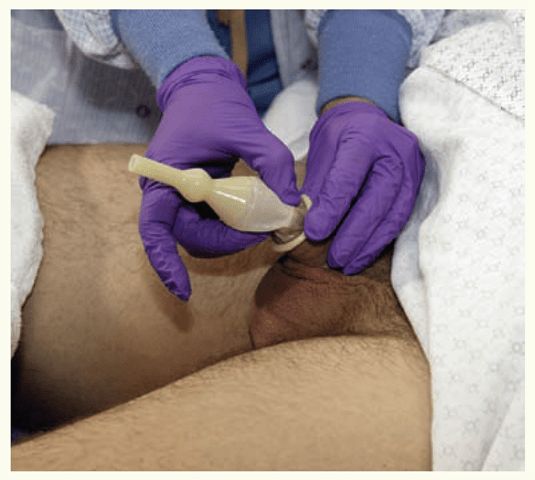 nurse inserting male catheter embarrassing