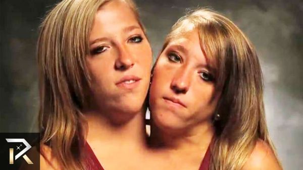 conjoined twins who got married