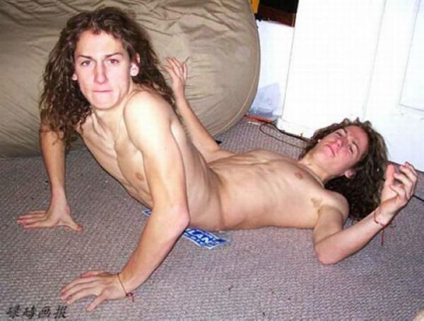 conjoined twins married