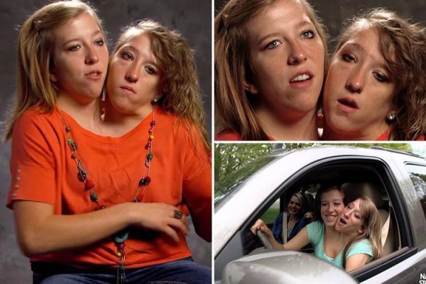 real twins conjoined at head