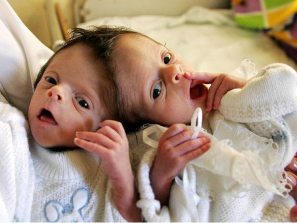 living conjoined twins