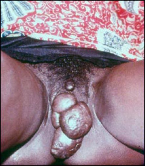 mutilated rectum