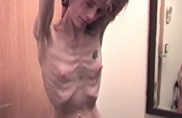 pregnant anorexic girls