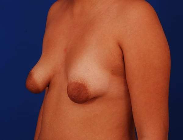 tubular puffy breasts youth
