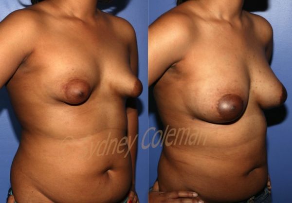 tubular breast implants