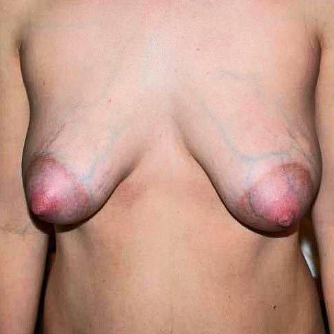 small tubular breasts