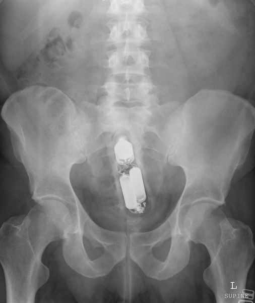 fat x ray